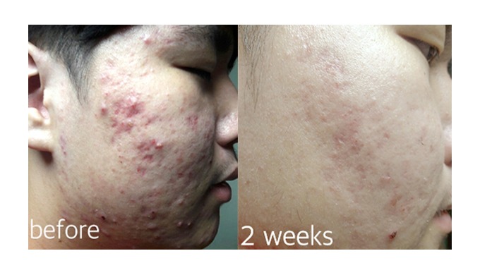 Acne exit foam cleansing