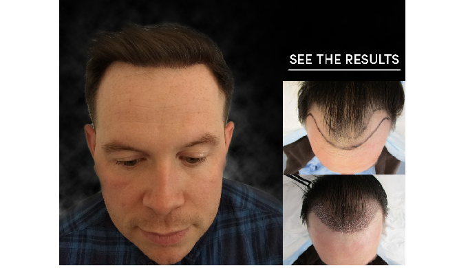If you’re considering hair transplantation, hair restoration or general hair thickening treatment, w...
