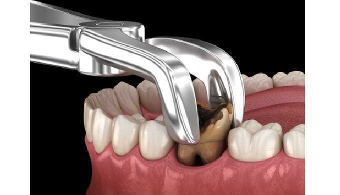 There are several reasons why it might be necessary to have one or more teeth extracted. Teeth can b...