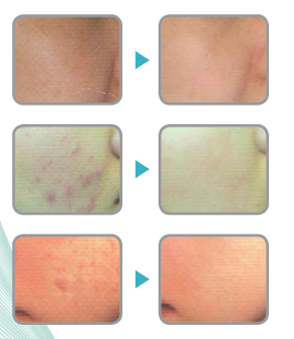 When you apply radio-frequency current to a body or facial tissue, deep-heat occurs and local temper...