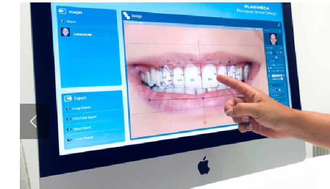 Este tratamiento de blanqueamiento dental consigue reducir los tonos en el esmalte, hasta provocar u...