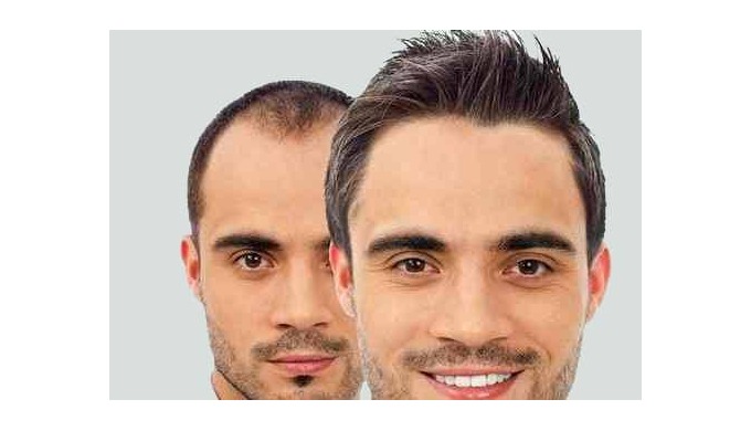 Hair Transplant in Ahmedabad | Hair replacement | Hair Transplant clinic in  Ahmedabad | Gujarat (by Clion Care)