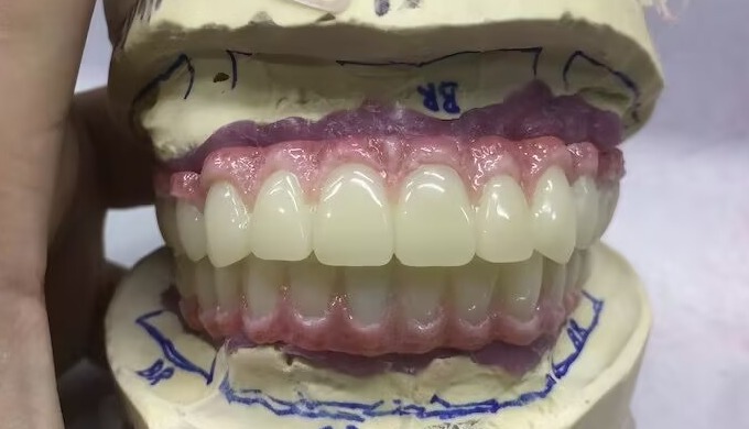 China Dental Lab Composite Implant Bridge MYY dental lab is quality dental lab from Shenzhen, China....
