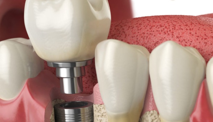Rediscover Your Smile with All On 4 Dental Implants If you’re tired of dealing with gaps in your smi...
