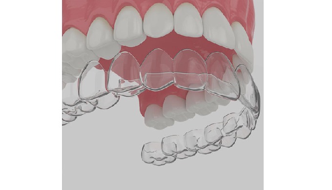 Your dentist in Brooklyn talks to you about the Invisalign cost and investment you’ll benefit from w...