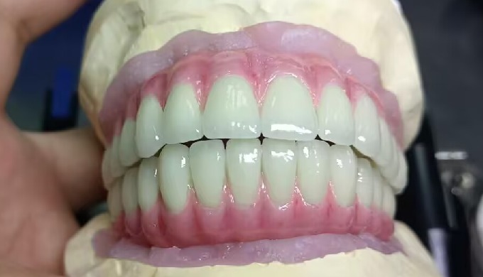 Implant Zirconia Bridge Implant zirconia bridge from MYY Dental Lab MYY Dental Lab is a high quality...