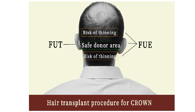 Crown - The Hair Transplant Experts, S-347 Panchsheel Park, Gr...