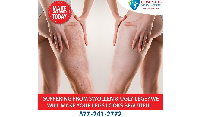 Highly Reliable Vein Treatments in NJ Healthy Legs Are Just One Phone Call Away! Over 95% Success Ra...