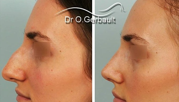 Rhinoplastie