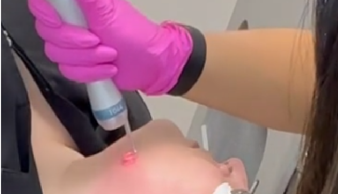 Minimize the look of fine lines and wrinkles, improve the apperance of acne scaring and rewind your ...