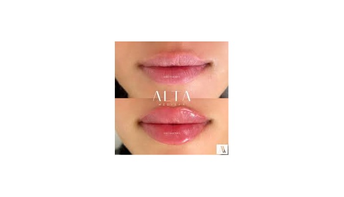 Dynamic Lip Sculpting ALTA Medispa’s Dynamic Lip Sculpting is a specialised, non-invasive technique ...
