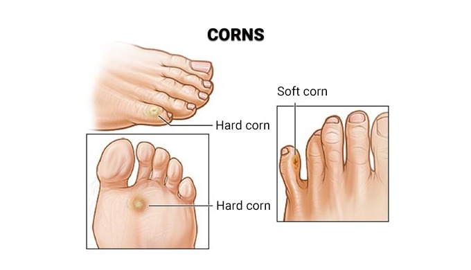 Foot corn removal is an effective option for treating unsightly and painful corns. We offer a variet...
