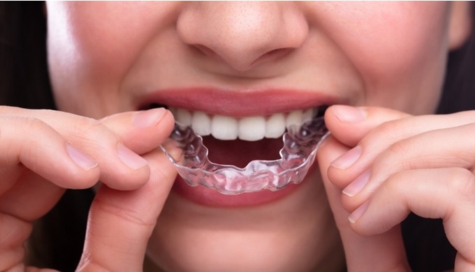 Dezy aligners are Invisible Braces, the best alternative to metal braces, designed to straighten you...