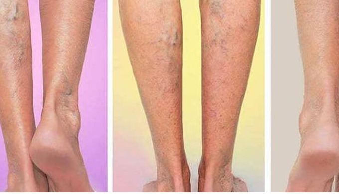 5 Tips to Prevent Varicose Veins Pain - Flowcare