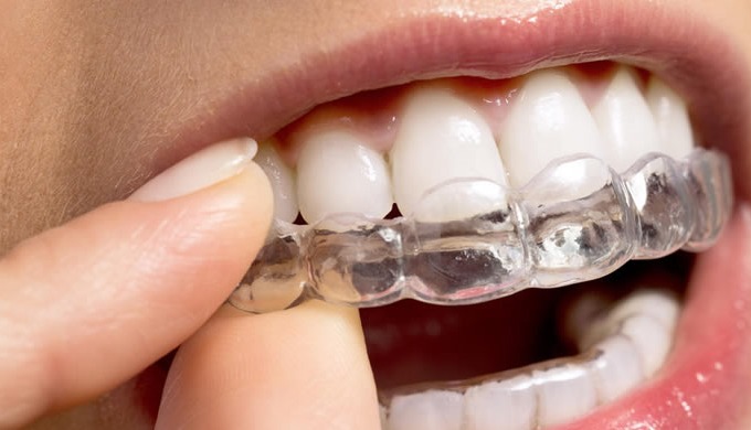 ClearMotionAligners les gouttières invisibles qui vous redonneront le sourire grâce à une solution s...