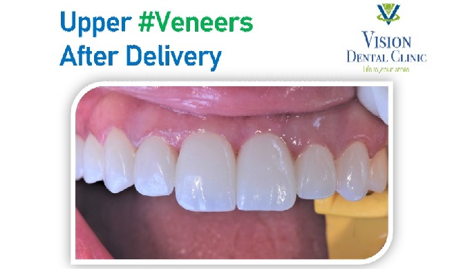 Dental Implant is a material or device placed in and or on oral tissues to support an oral prosthesi...