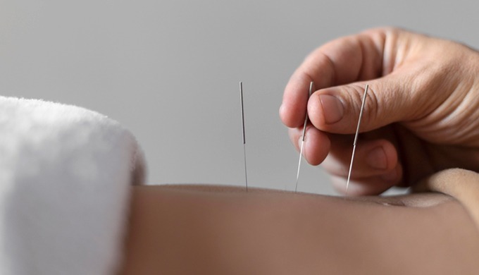 Acupuncture, this practice entails the insertion of thin needles at specific points on the body to h...