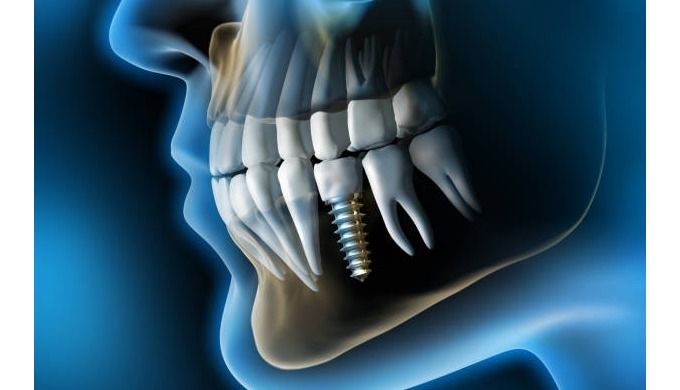 En la clínica dental Quirutech realizamos todo tipo de implantes dentales, nuestro equipo está en co...