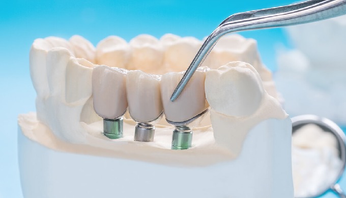 Los implantes dentales son una raíz artificial de elementos metálicos que se insertan quirúrgicament...