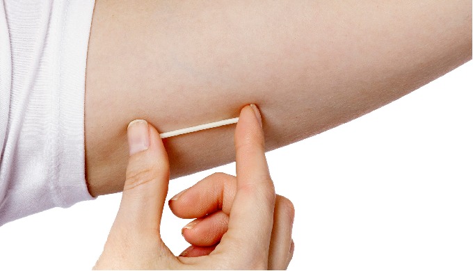 Nexplanon is a hormone-releasing birth control implant for use by women to prevent pregnancy for up ...