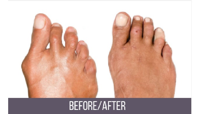 Your podiatric foot and ankle surgeon Dr. Rimawi offers a variety of the newest treatment options (m...
