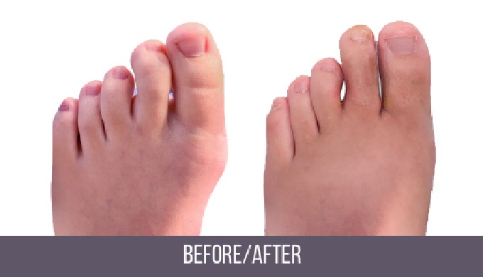 Your hammertoe surgery specialist offers the newest treatment options (minimal incision, no scar) fo...